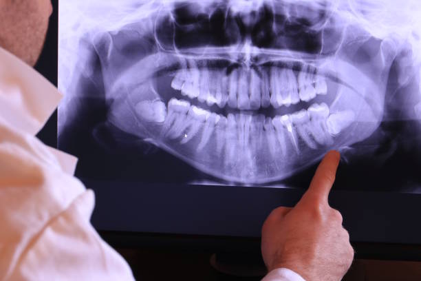 Best Emergency Root Canal Treatment in Griffith, IN